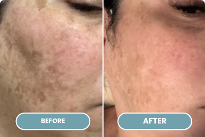 Dark Spots & Age Spots