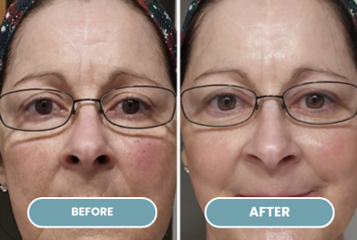 Fine Lines & Wrinkles